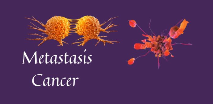 Understanding Metastasis Cancer symptoms